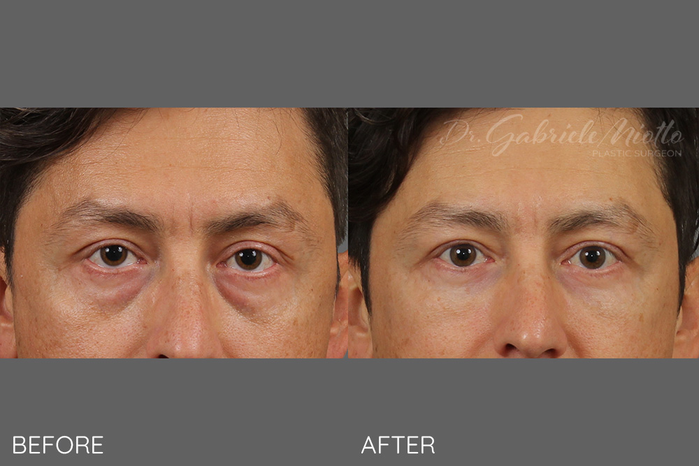 Bilateral upper and lower blepharoplasty eyelid lift with fat grafting to the cheeks, upper and lower eyelids