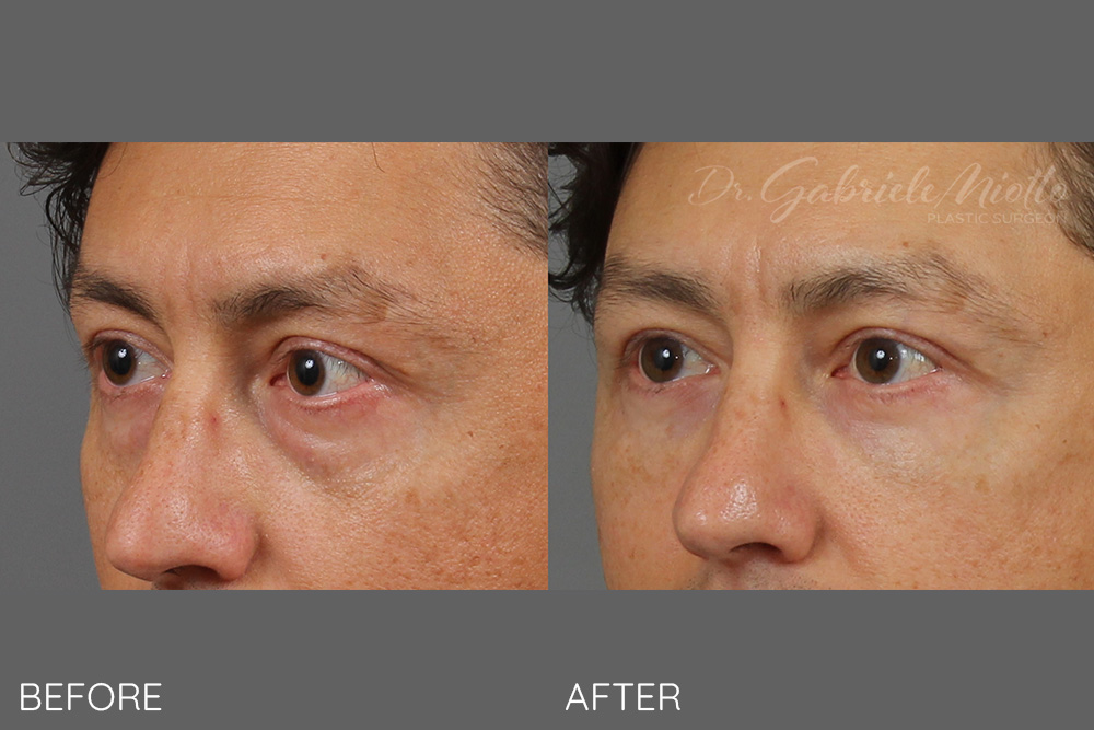 Bilateral upper and lower blepharoplasty eyelid lift with fat grafting to the cheeks, upper and lower eyelids