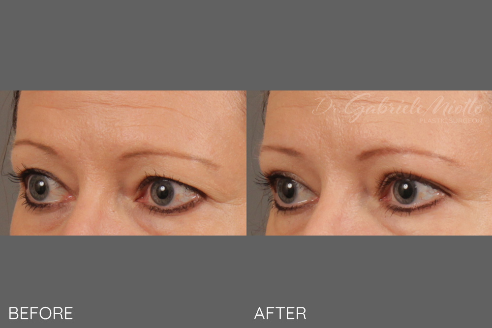 Bilateral upper blepharoplasty