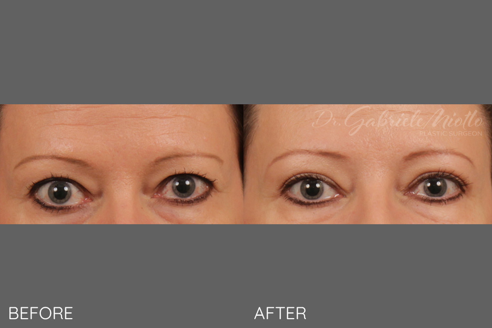 Bilateral upper blepharoplasty