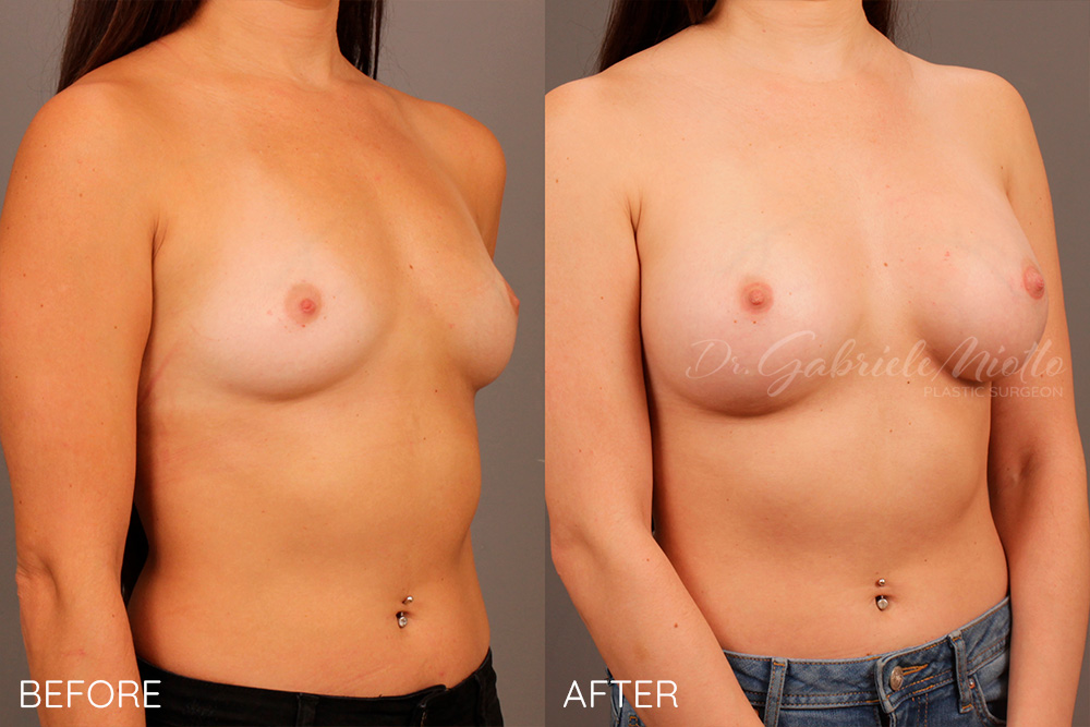 Breast Augmentation