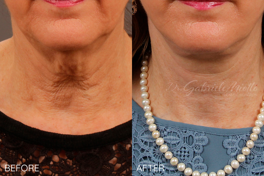 Neck Lift with Platysmaplasty