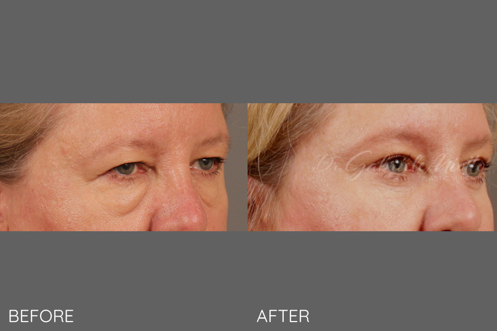 Lateral brow lift, upper and lower blepharoplasty