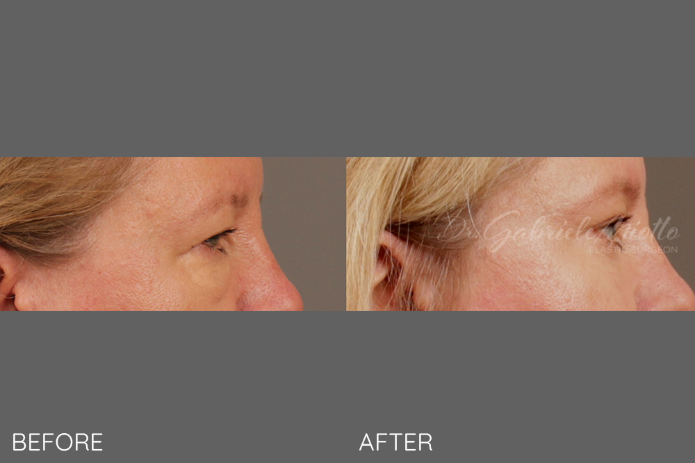 Lateral brow lift, upper and lower blepharoplasty