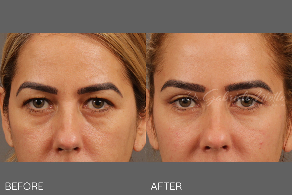 Lateral brow lift, upper blepharoplasty, fat grafting to upper and lower lids