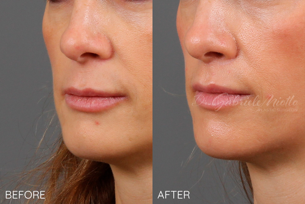 Lip lift