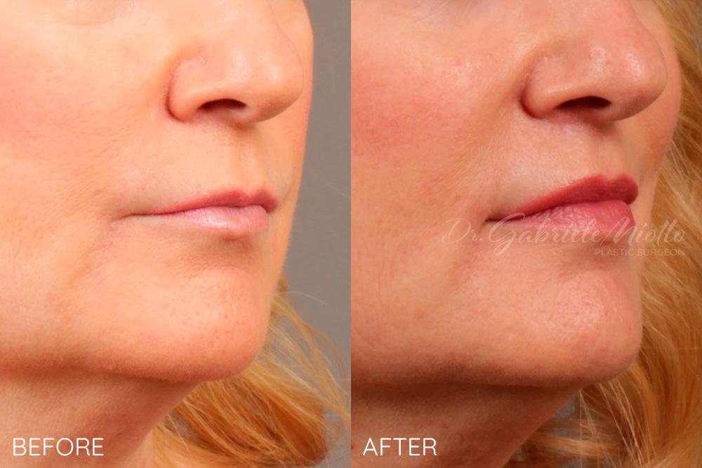 Lip lift and lip fillers lower lip