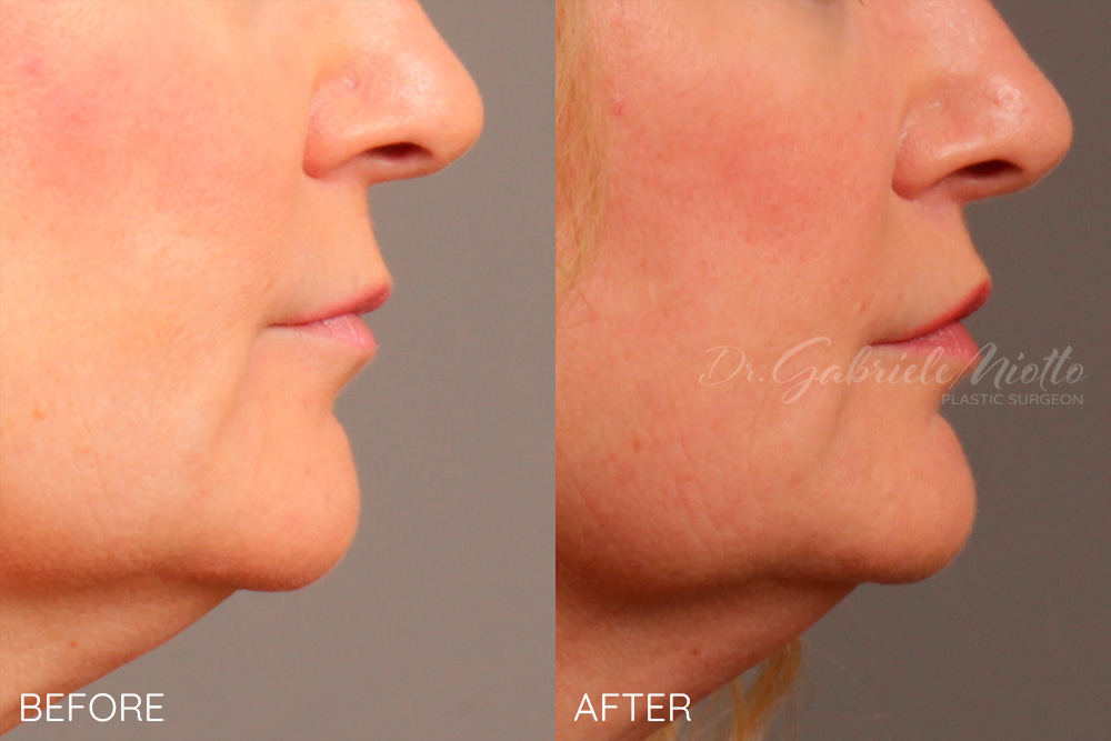 Lip lift and lip fillers lower lip