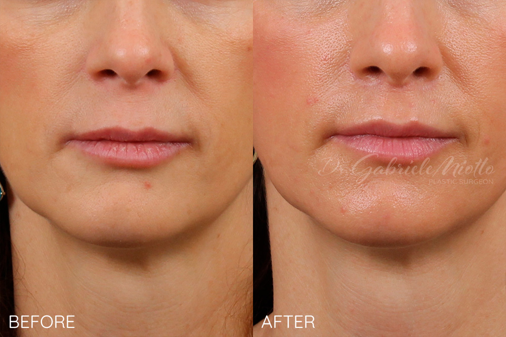 Lip lift