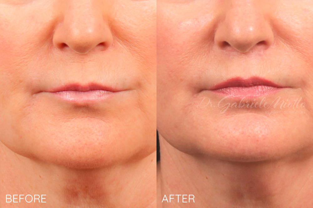 Lip lift and lip fillers lower lip