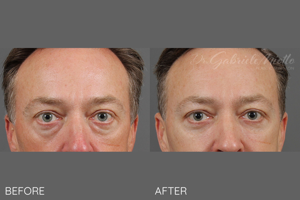 Lower eyelid blepharoplasty and fat grafting to the lids and cheeks