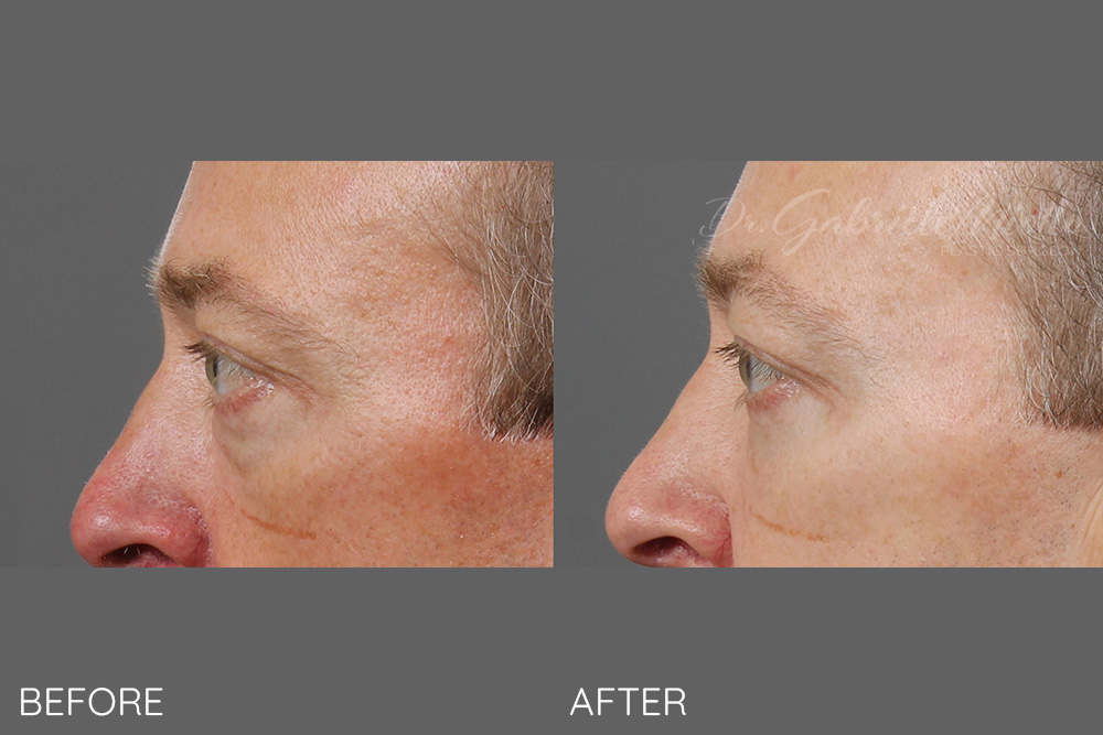 Lower eyelid blepharoplasty and fat grafting to the lids and cheeks