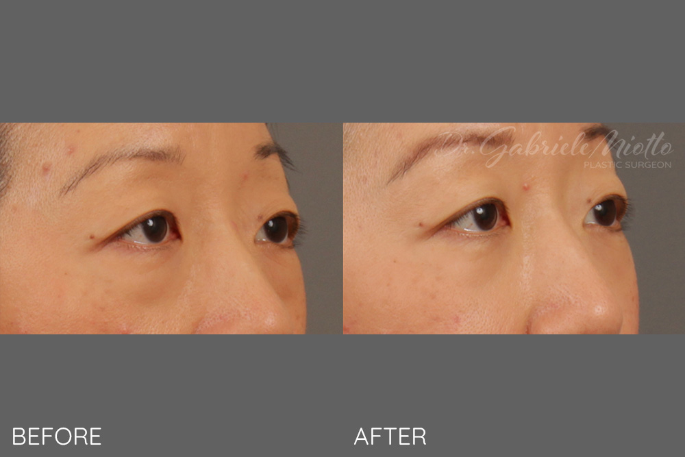 Lower lid blepharoplasty, transconjunctival (scarless)