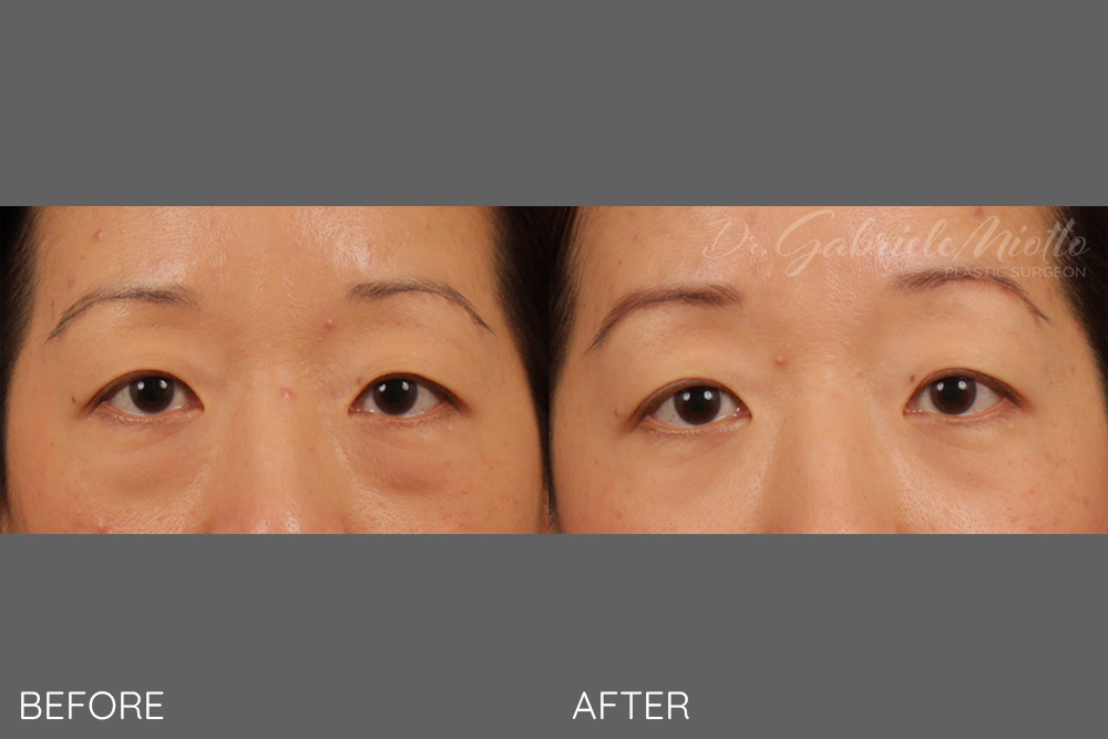 Lower lid blepharoplasty, transconjunctival (scarless)