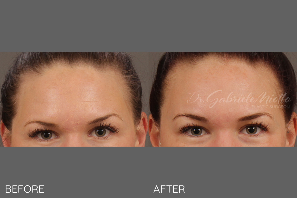 Unilateral brow lift