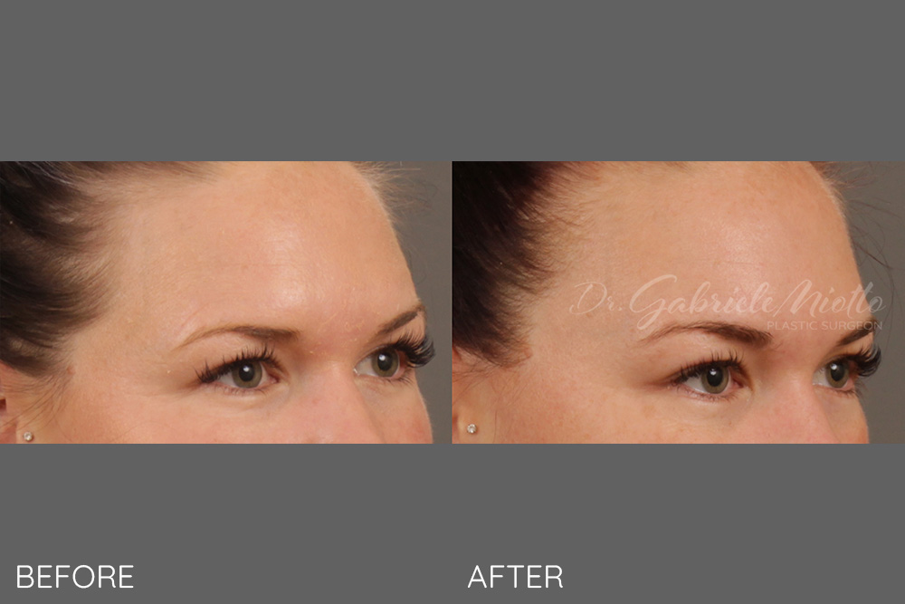 Unilateral brow lift
