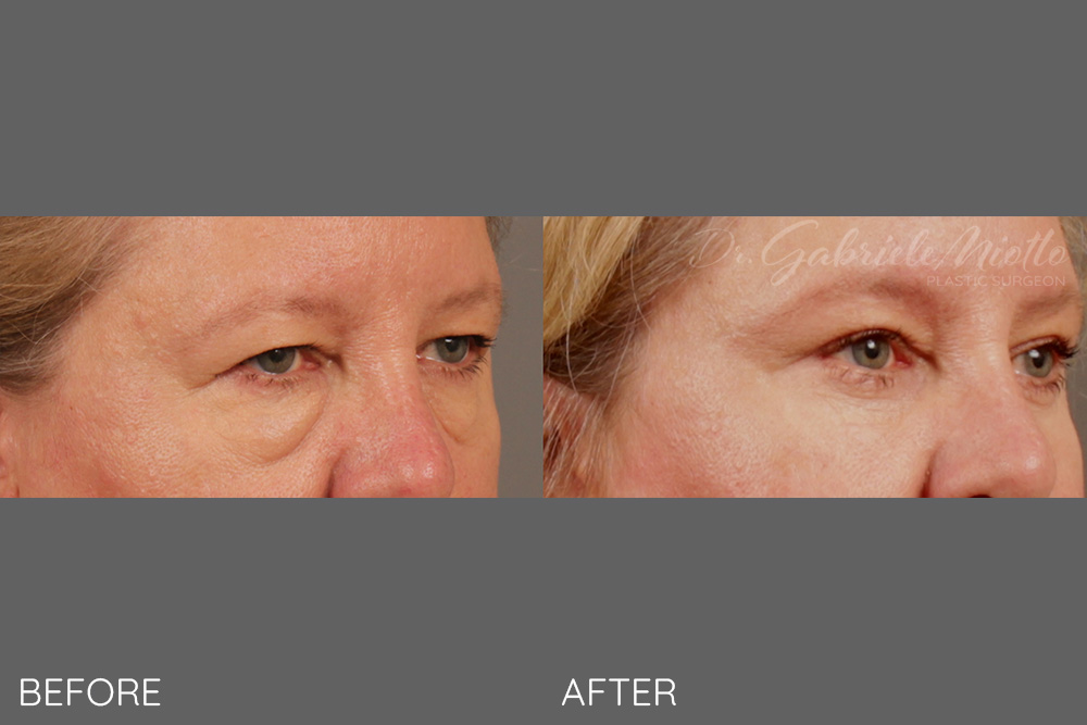 Upper and lower eyelid blepharoplasty