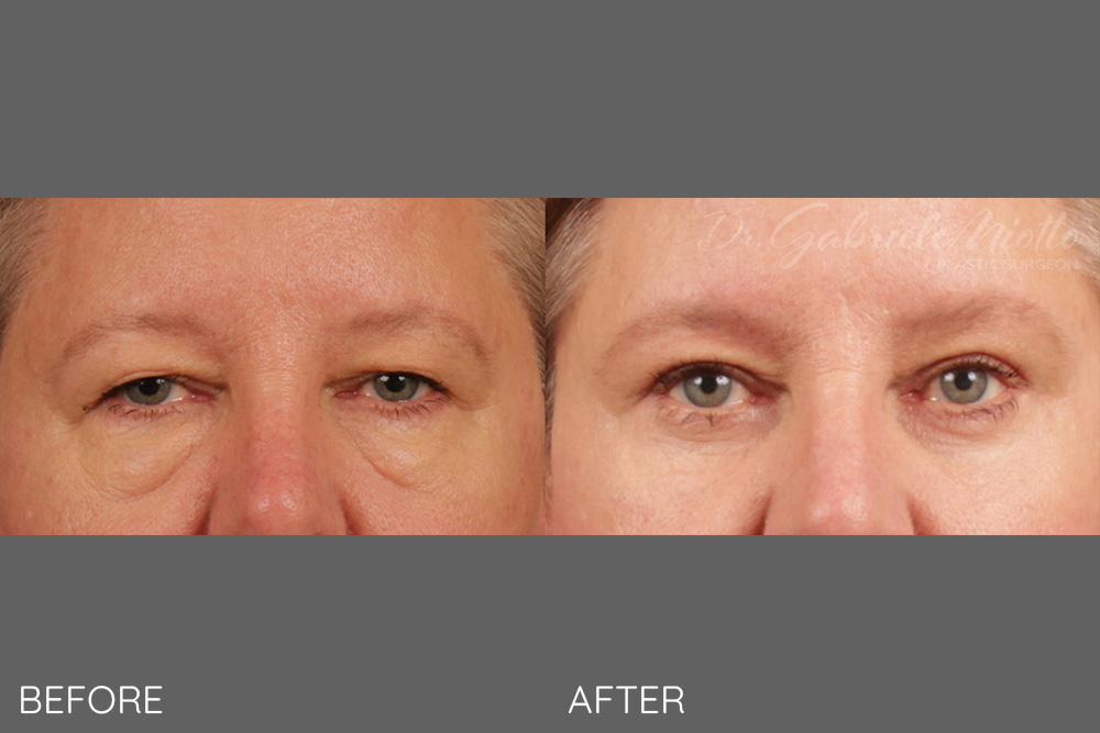 Upper and lower eyelid blepharoplasty