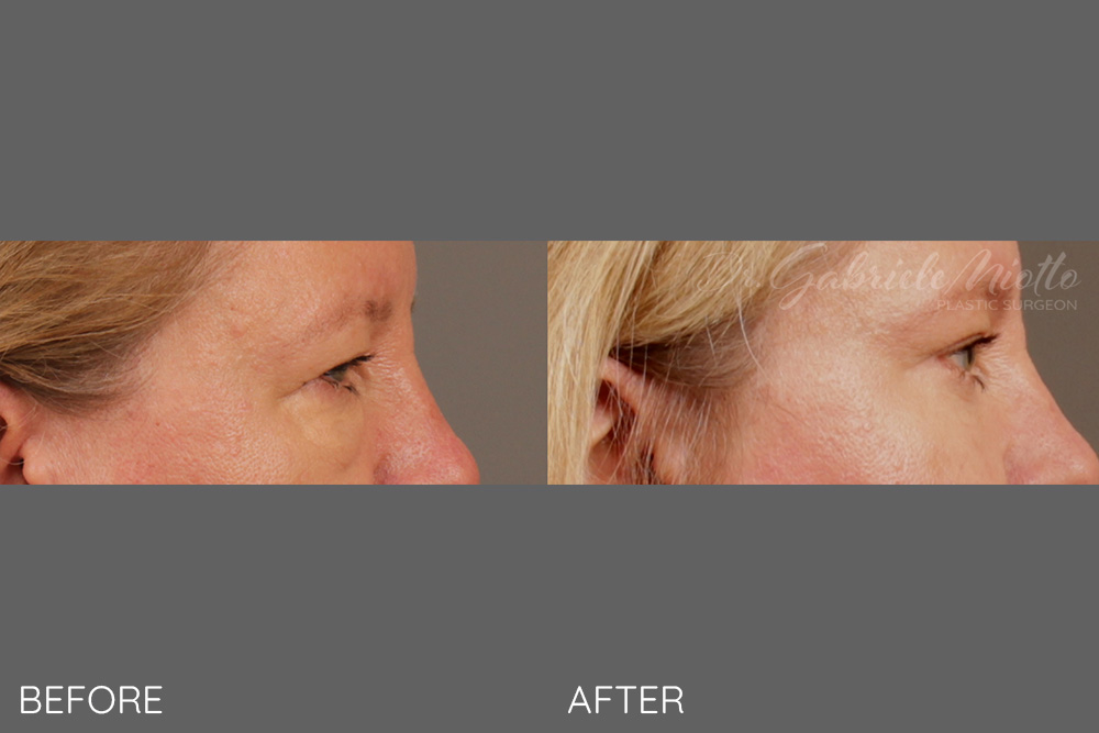 Upper and lower eyelid blepharoplasty
