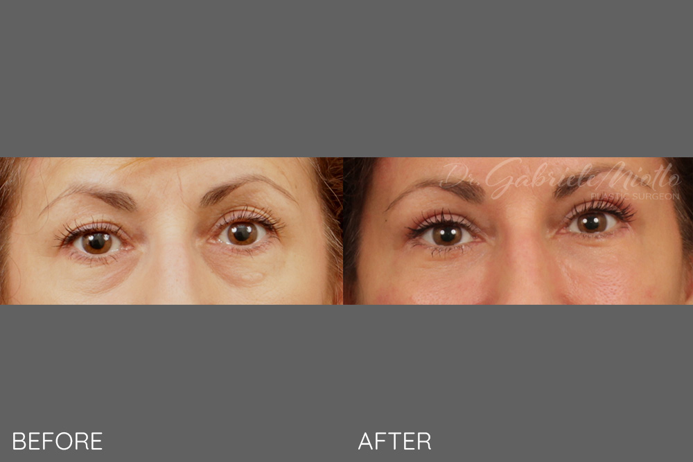 Upper and lower eyelid lift blepharoplasty