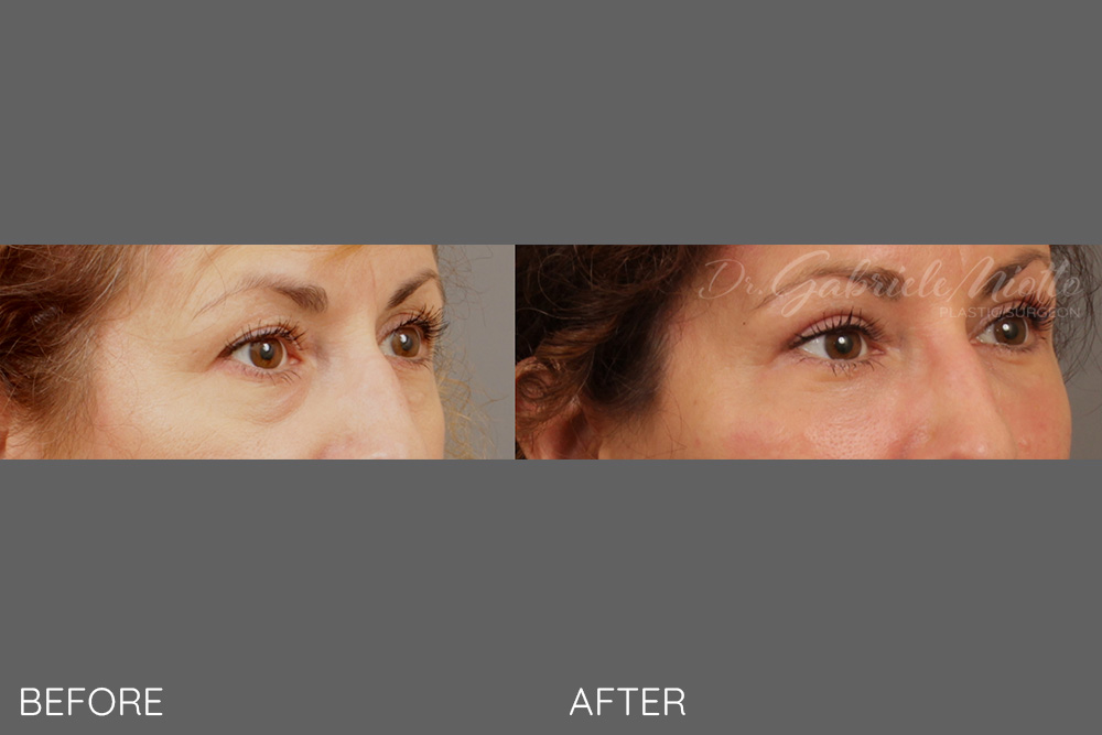 Upper and lower eyelid lift blepharoplasty