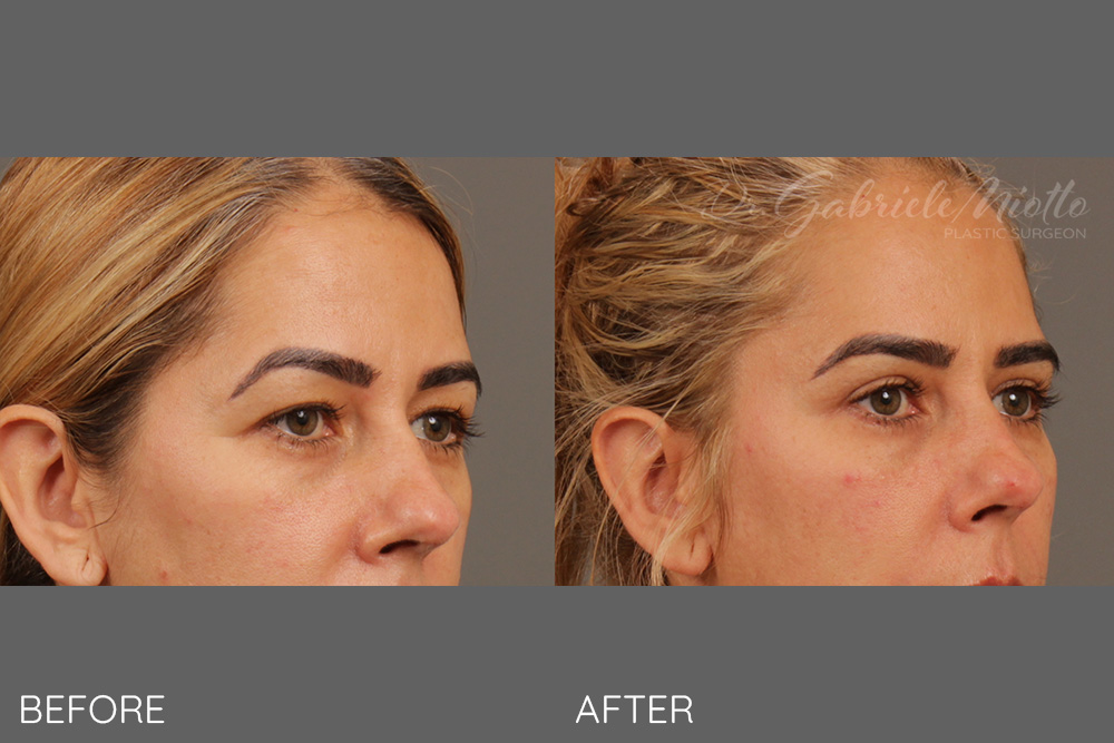 Upper eyelid blepharoplasty, lateral brow lift, fat grafting to upper and lower lids
