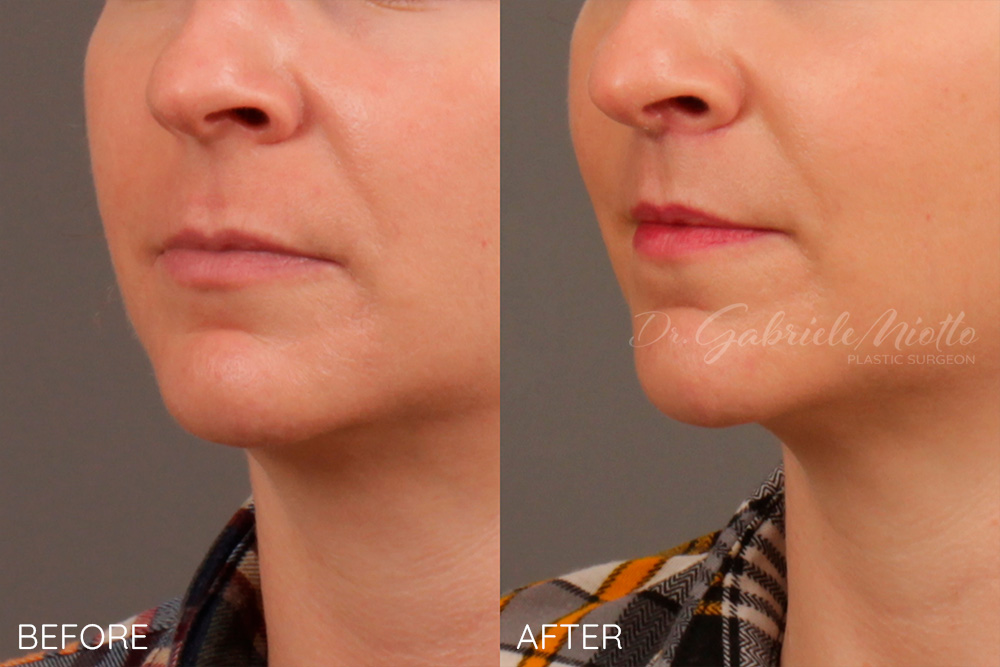 Lip Lift Before & After Photos - ME Plastic Surgery