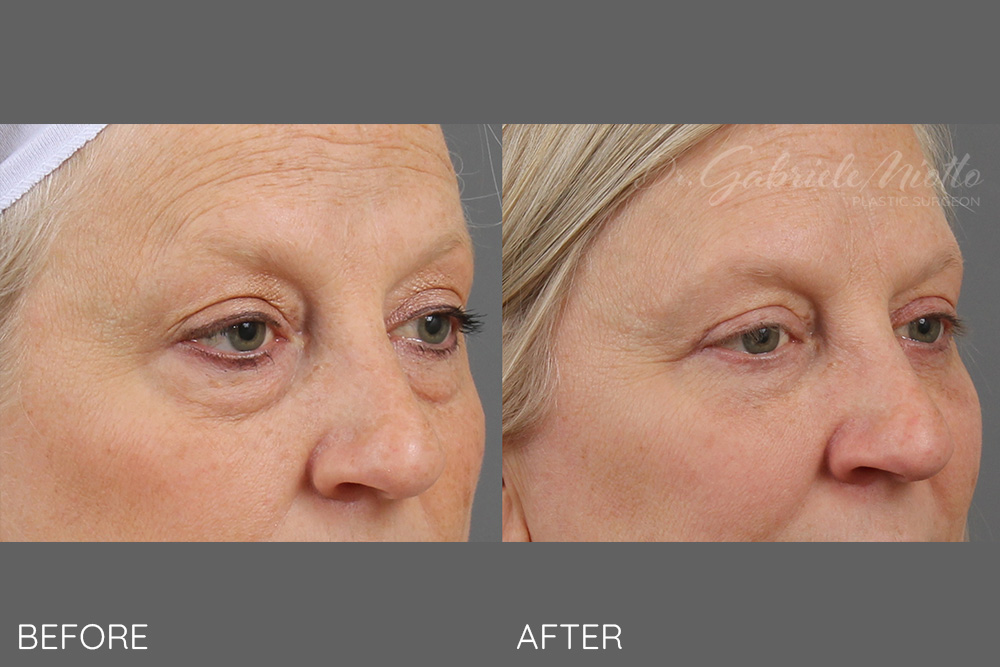 Lower eyelid blepharoplasty with skin muscle flap and fat transposition