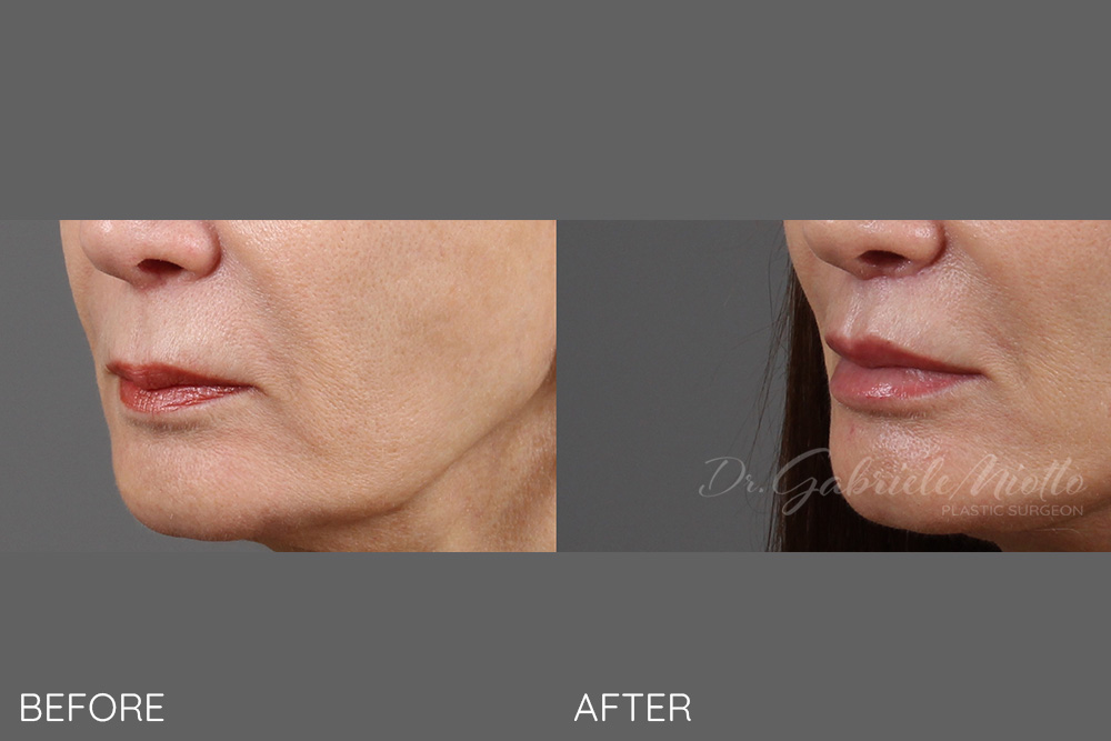 Lip Lift and lip fillers