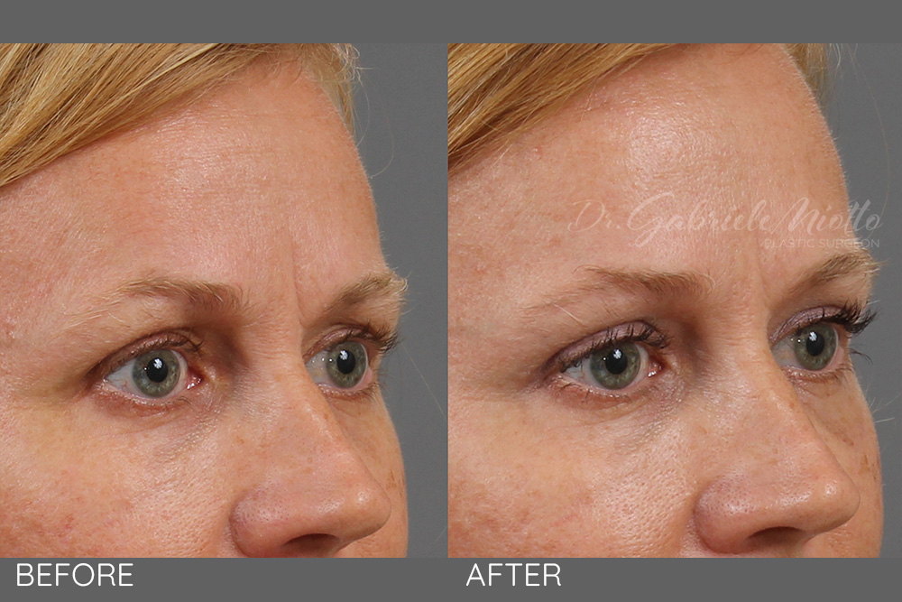 Upper eyelid lift- blepharoplasty, skin only