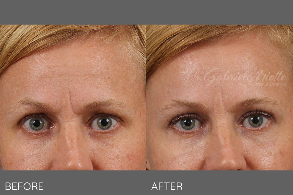 Upper eyelid lift- blepharoplasty, skin only