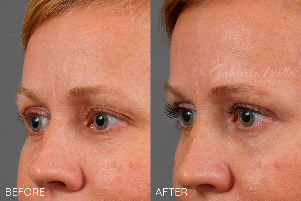 Upper eyelid lift- blepharoplasty, skin only