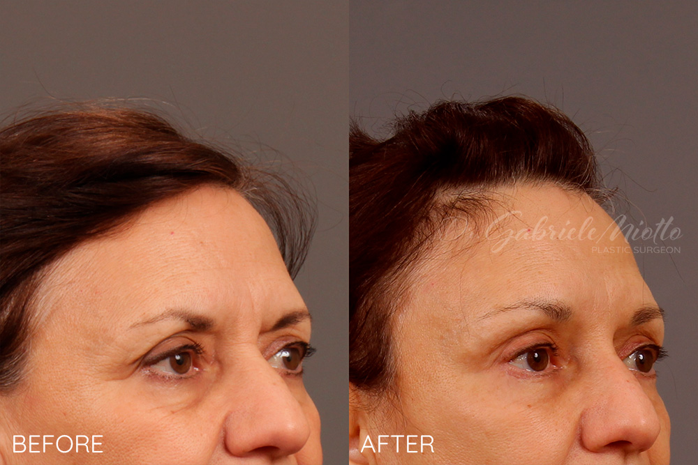 Brow lift, upper eyelid blepharoplasty, lower eyelid blepharoplasty, fat grafting to eyelids