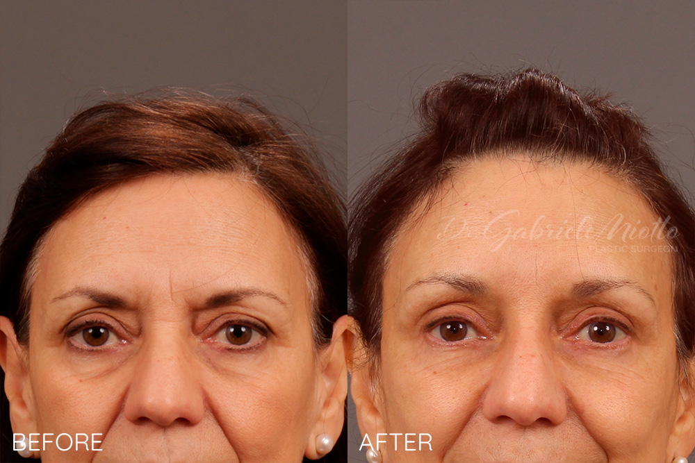Brow lift, upper eyelid blepharoplasty, lower eyelid blepharoplasty, fat grafting to eyelids