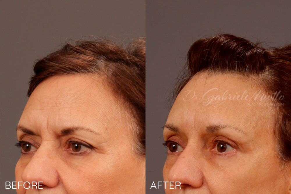 Brow lift, upper eyelid blepharoplasty, lower eyelid blepharoplasty, fat grafting to eyelids