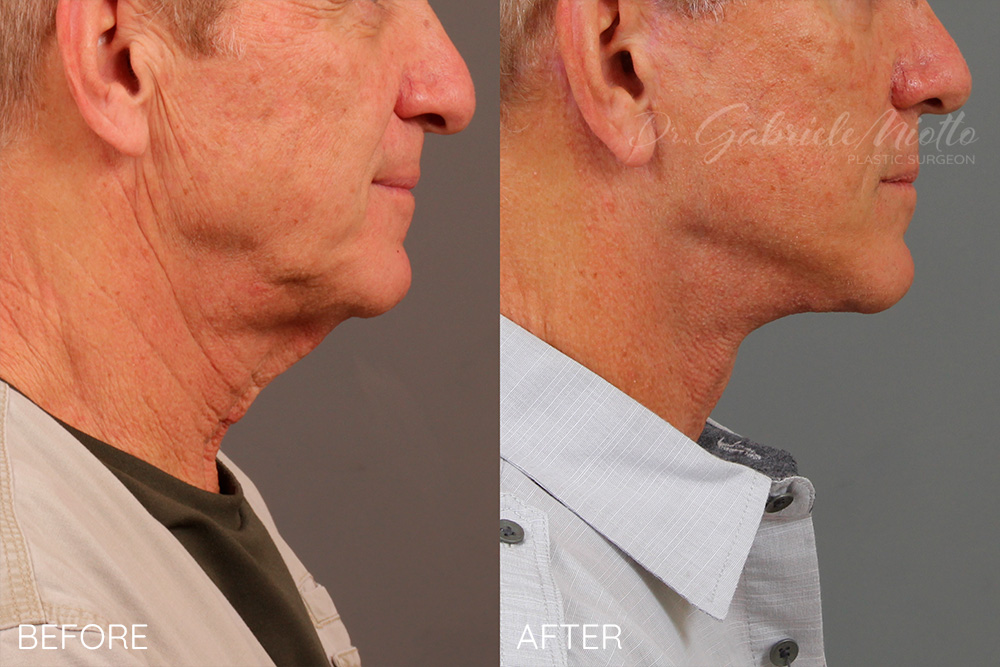 Necklift with platysmaplasty and facelift